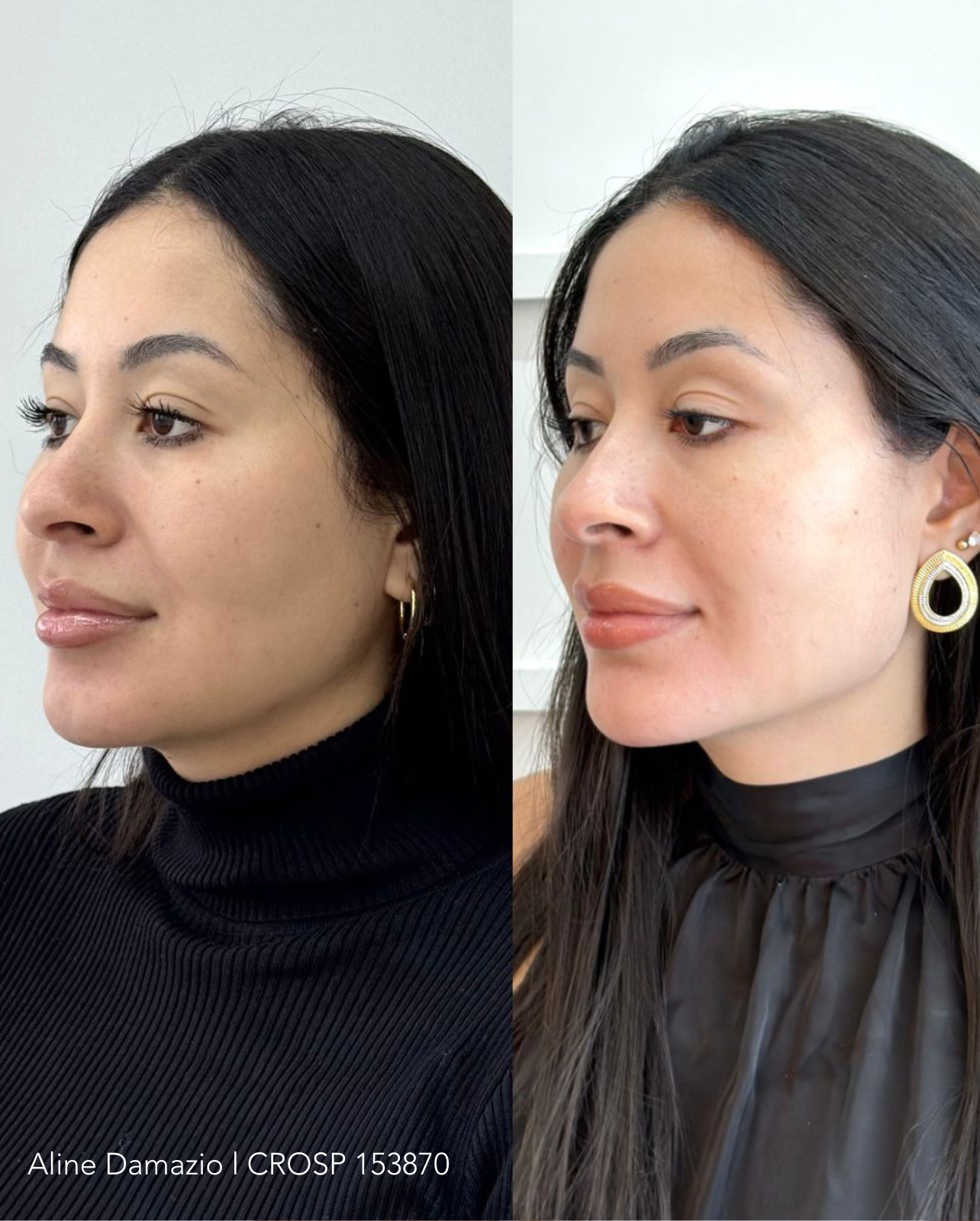 harmonização facial botox bioestimulador de colágeno clinica em campinas