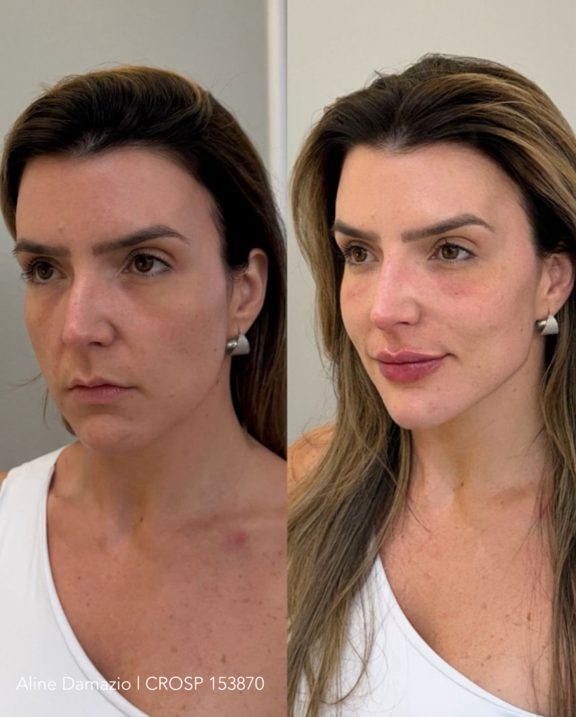 Antes e depois de contorno papada em Campinas 