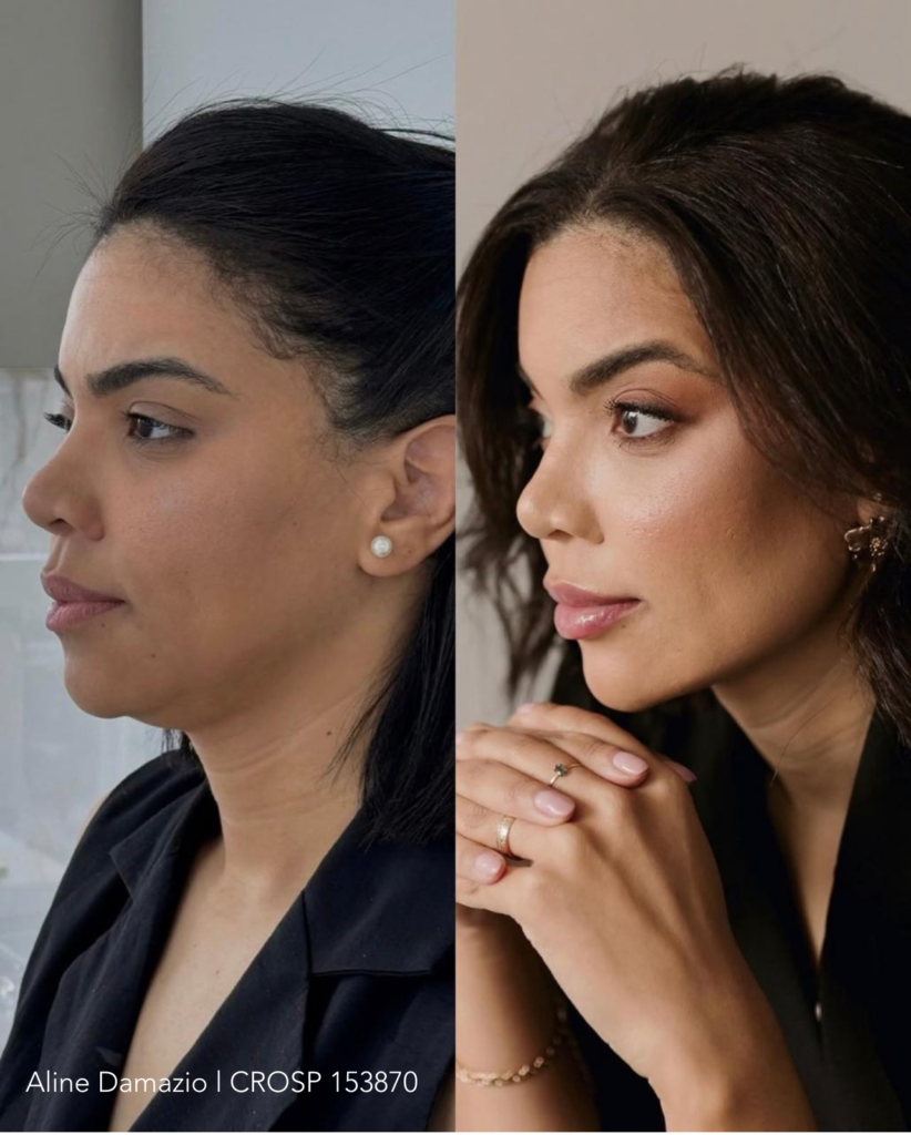 Resultado de harmonização facial feminina com contorno mandibular em Campinas 